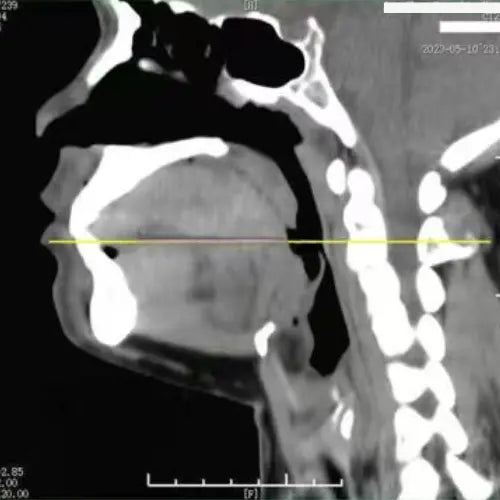 cette image représente le scanner du patient avant l'utilisation du dispositif Z3 pro de qontroler contre les ronflements et l'apnée du sommeil