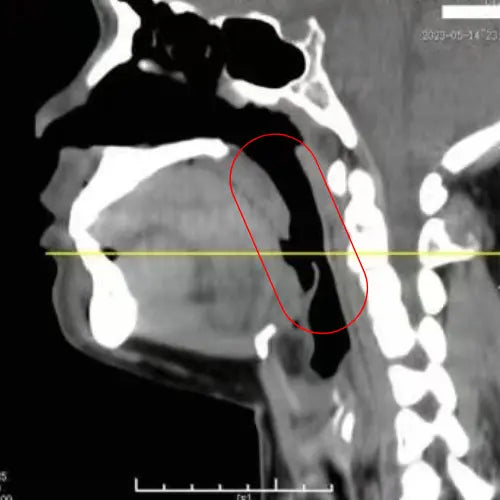 cette image représente le scanner du patient avant l'utilisation du dispositif Z3 pro de qontroler contre les ronflements et l'apnée du sommeil